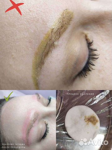 Удаление татуажа лазером, ремувером